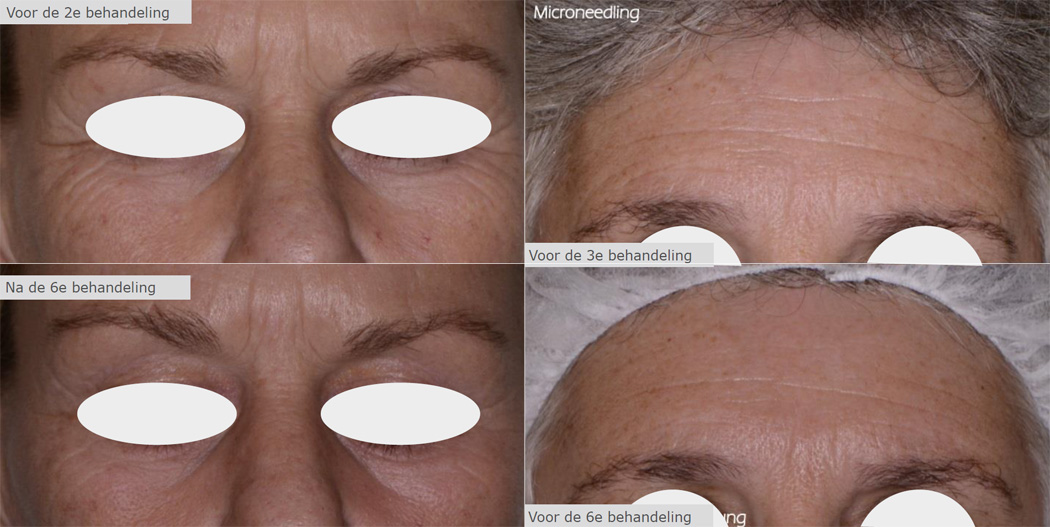 Lange termijn effecten