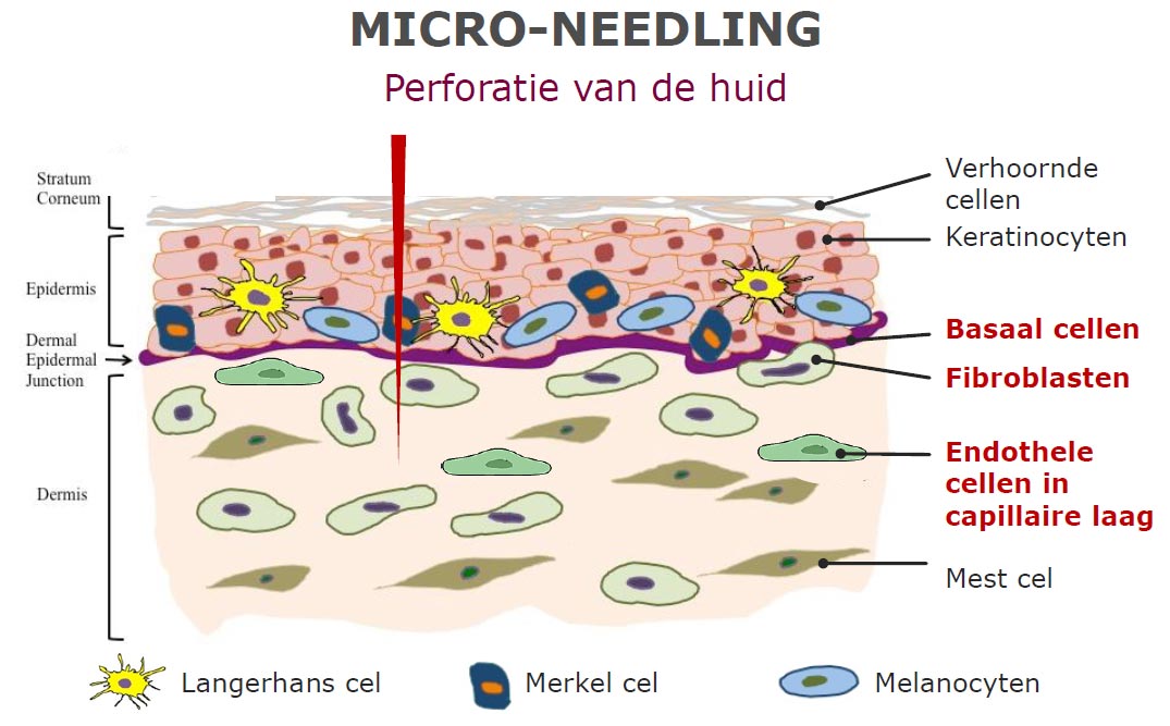 Perforatie van de huid